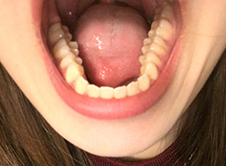 受け口なのと歯並びが悪いことが気になっています 私の場合 マウスピースでの治療は可能ですか 成瀬歯科矯正クリニック 中野区